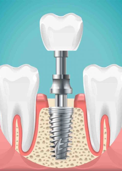 Dental surgery. Tooth implant cut vector illustration. Healthy teeth and dental implant, stomatology poster. Implant dental metal screw in gum